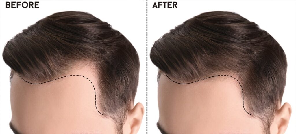 Unlocking Confidence: A Comprehensive Guide to Hair Transpla