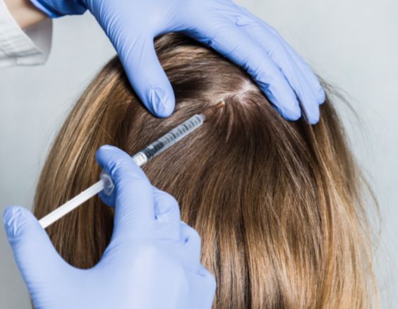 PRP hair therapy for women over 40