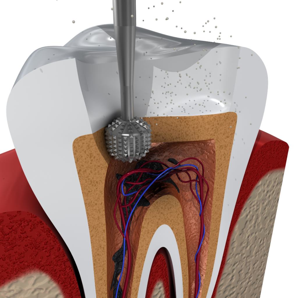 New PThe Ultimate Guide To Understanding Root Canal Treatost