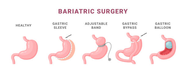 Bariatric Surgery in Abu Dhabi: Real Success Stories