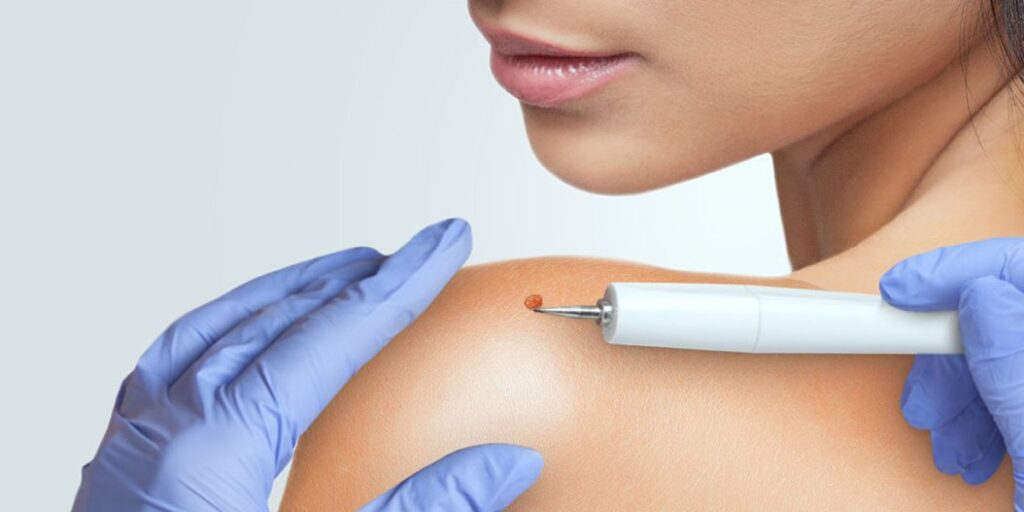 Celebrating Your Unique Beauty After Mole Removal in Dubai