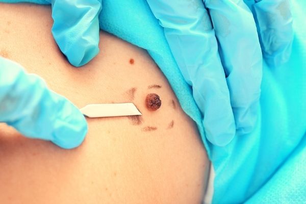 Mole Removal: A Man’s Guide to Recovery