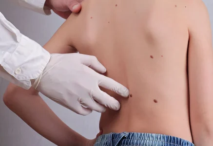 A Luxurious Mole Removal Experience in Dubai