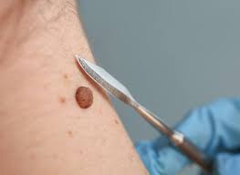 Mole Removal for Men: What to Know