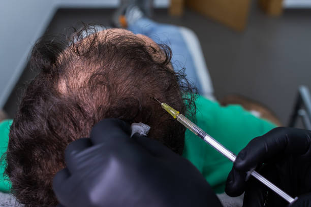 PRP Hair Treatment in Abu Dhabi: Hair Restoration Breakthrou