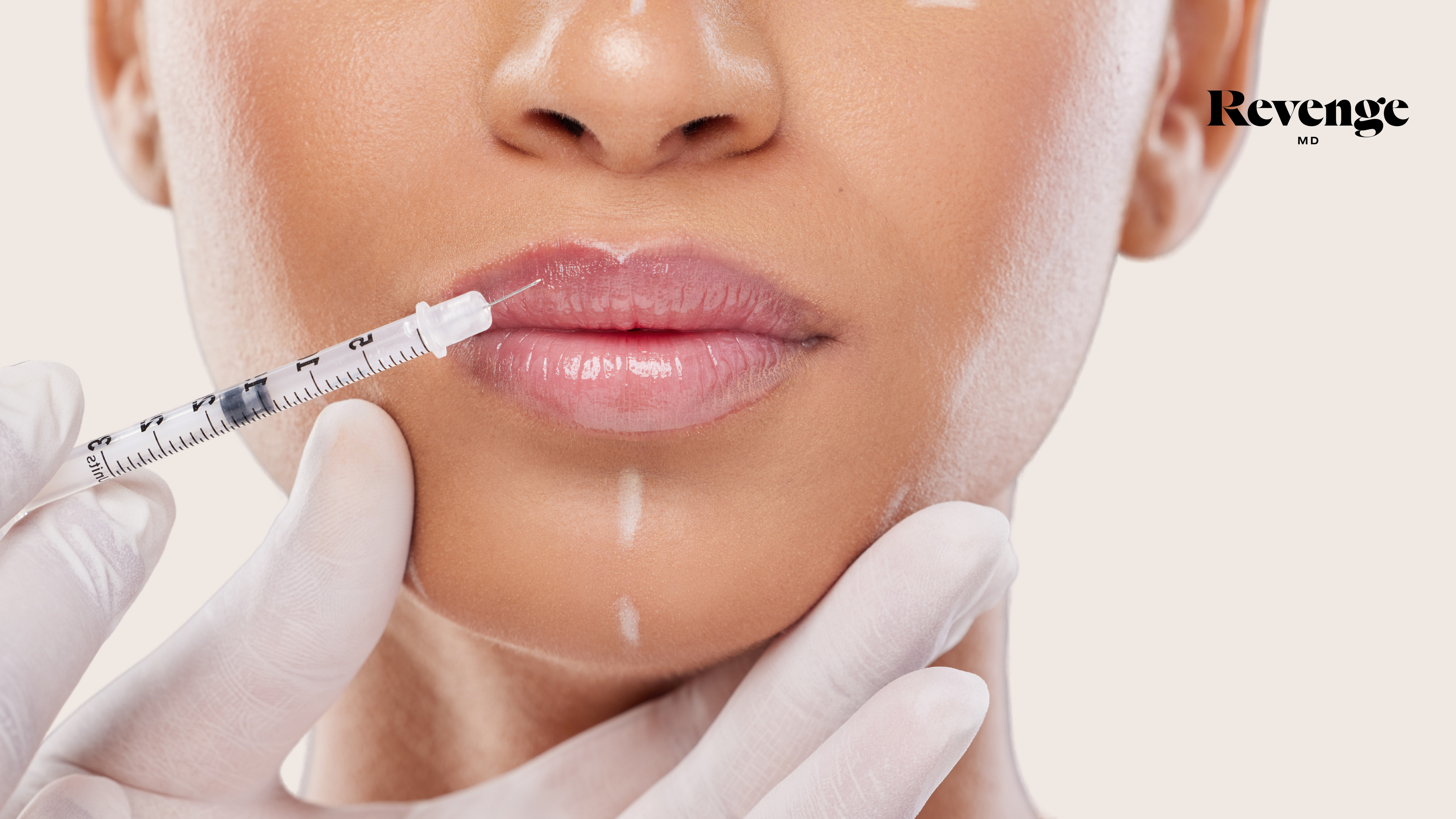 Enhance Your Pout With Confidence Through Lip Fillers