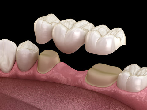 Benefits of Choosing a Crown and Bridge for Missing Teeth