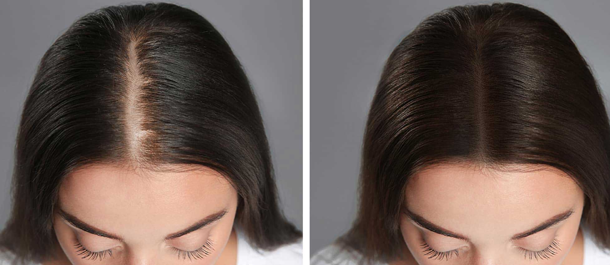 Best Hair Transplant in Lahore: Your Guide to the Top Surgeons