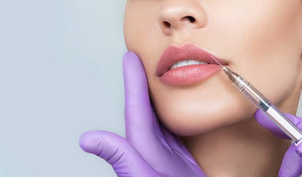 Russian Lip Fillers in Abu Dhabi: The Latest Beauty Trend