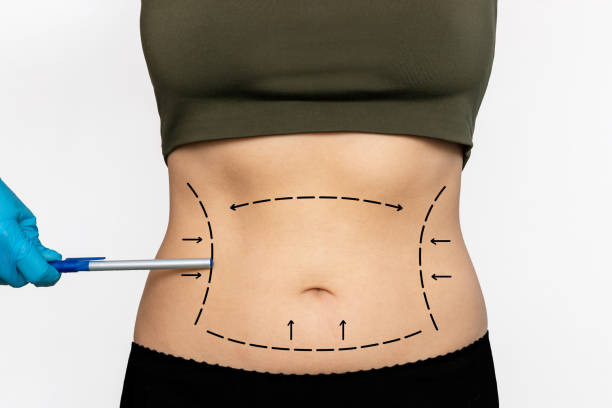 Best Clinics for Liposuction in Abu Dhabi: A Complete Guide