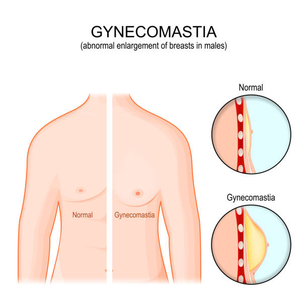 Gynecomastia in Al Ain: Transformative Results Await You