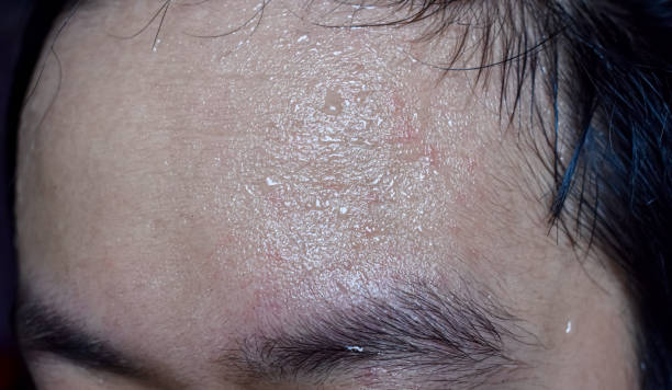 Hyperhidrosis Treatment in Abu Dhabi: Regain Your Confidence