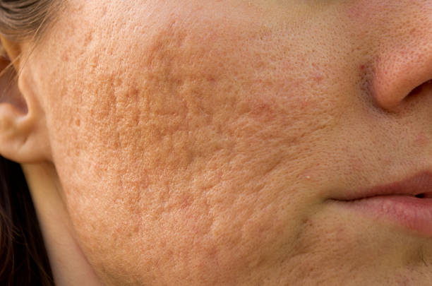 Acne Treatment in Abu Dhabi: A Clear Choice for Skin