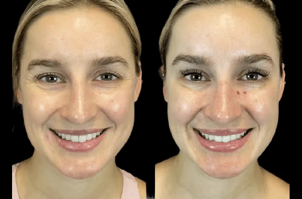 Get An Amazing Botox Offer at Enfield Royal Clinic In Dubai