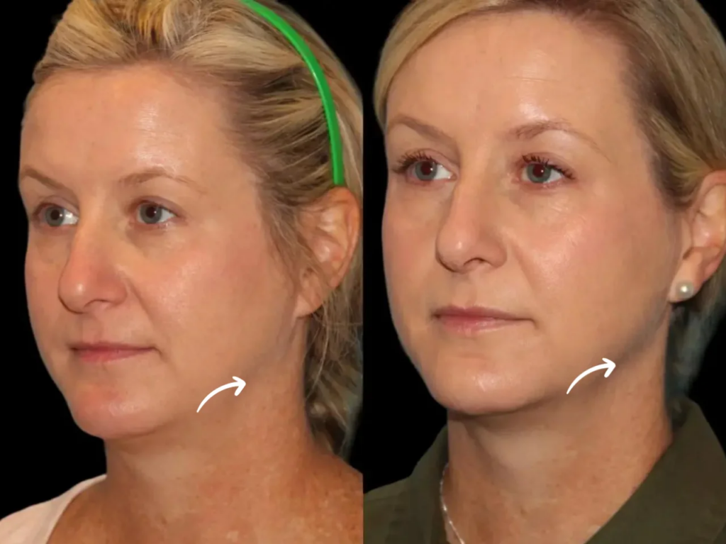 How Sculptra Injections in Dubai Can Improve Skin Texture