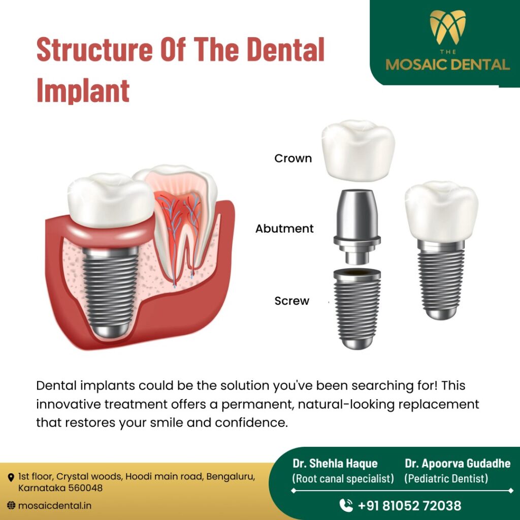 Choosing the Best Implantologist in Bangalore