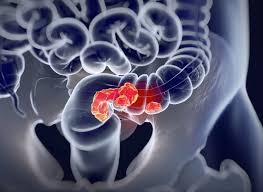Colorectal Cancer Drug Pipeline Analysis Report 2024