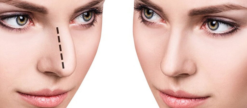 Rhinoplasty Cost in Dubai UAE
