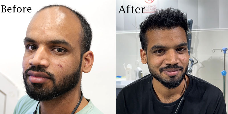 Best Hair Transplant in South Delhi