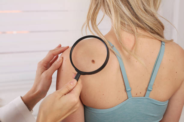 5 Things to Expect from Benign Mole Removal Treatment in Riy