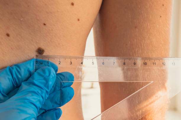 How to Choose Mole Removal Treatment in Riyadh