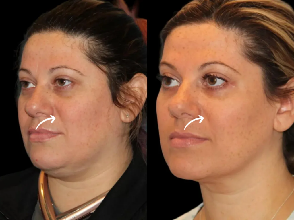 Sculptra Fillers Treatments in Dubai for Volume Restoration