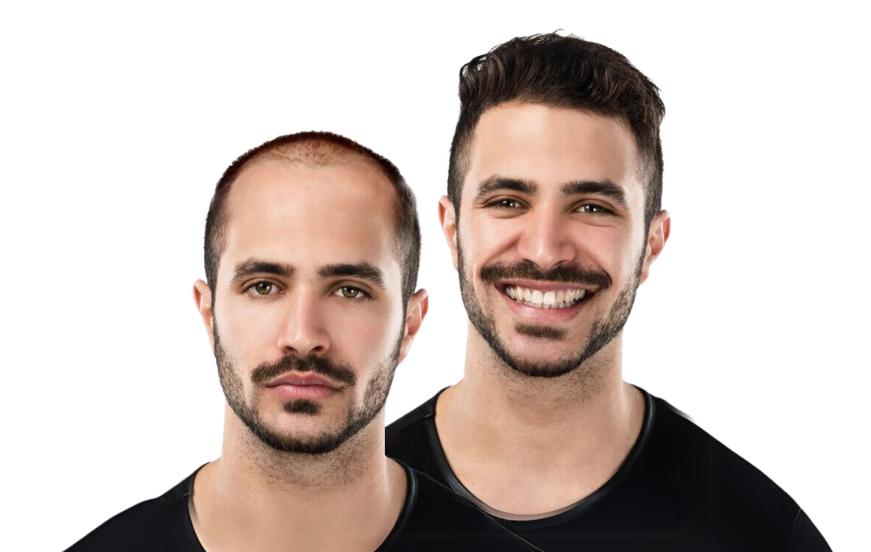 Why Hair Transplant in Islamabad is the Best Decision