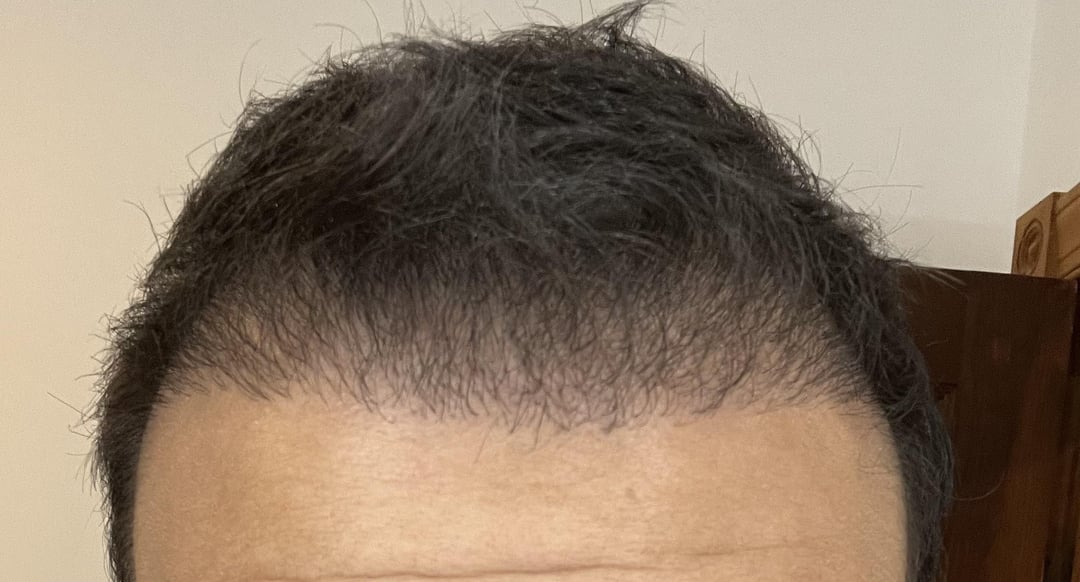 What Are the Risks Involved in Hair Transplants?