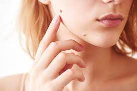 Consider When Choosing a Wart Removal Clinic in Dubai
