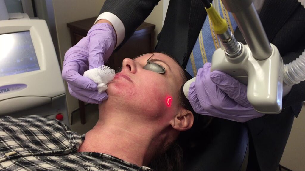 Where Can You Find an All-Inclusive Price for Fractional CO2 Laser Treatment?