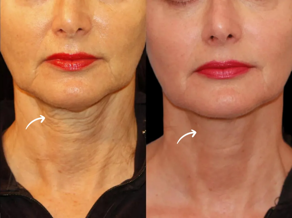 Sculptra Fillers Treatment in Dubai for Nasolabial Folds