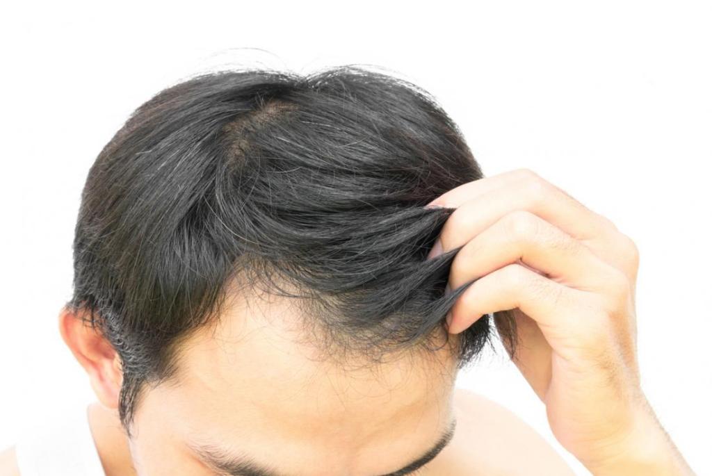 How Can You Track Progress with Finasteride for Hair Loss?