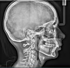 Comprehensive Guide to X-Ray OPG Scan in Bengaluru: Benefits, Process & Cost