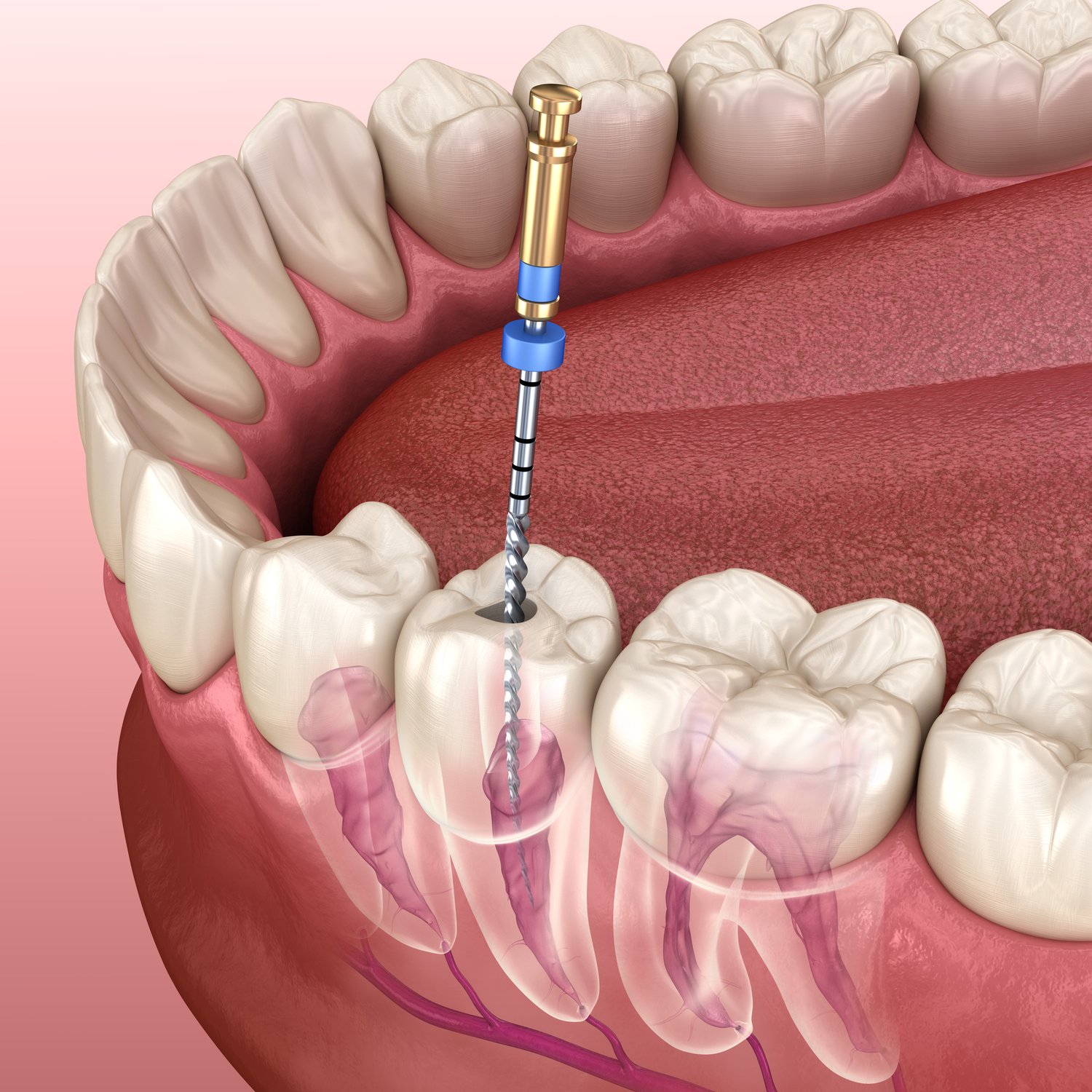 Signs You Might Need a Root Canal