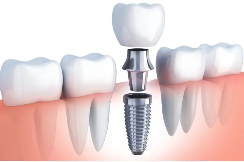 Teeth Whitening in McKinney, TX: Achieve a Brighter, Whiter