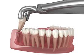 Wisdom Tooth Extractions: When Is It Necessary?