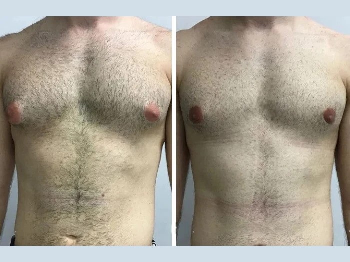 Gynecomastia in Dubai: Myths and Facts You Should Know