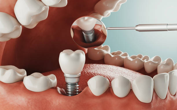 Dental Implants: The Best Solution for Missing Teeth