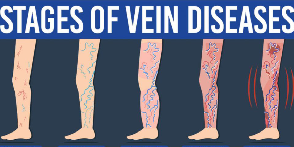 Recognizing and Treating Early-Stage Leg Ulcers