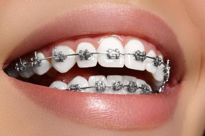 Laughing Gas in McKinney, TX: A Stress-Free Dental Experienc