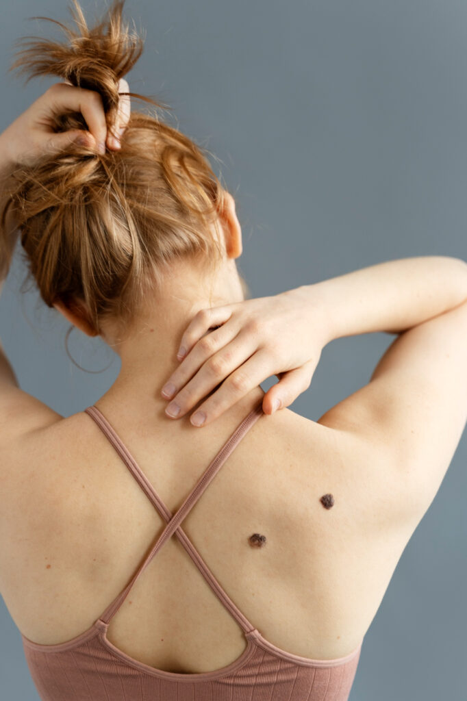 Is Laser Wart Removal Worth the Price in Islamabad?