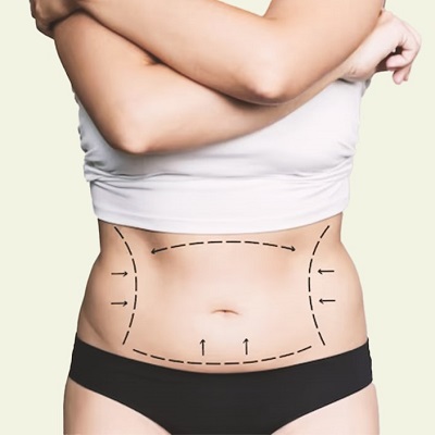 Nano Fat Grafting: The Future of Facial Rejuvenation in Musc