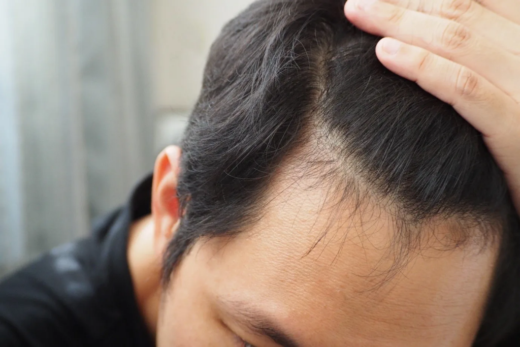 Can Women Use Finasteride for Hair Loss?