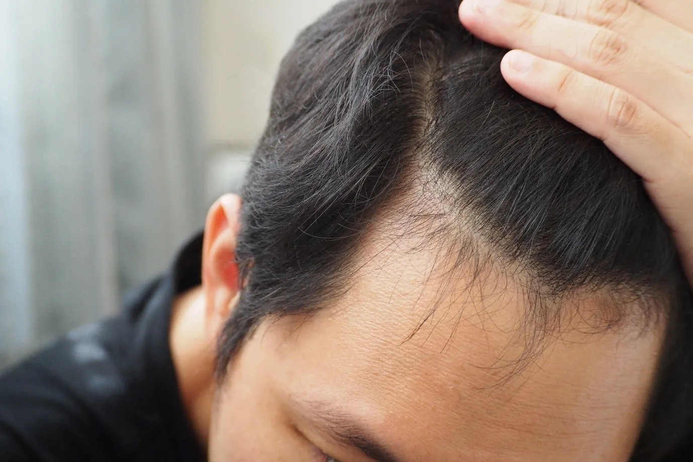 Can Women Use Finasteride for Hair Loss?