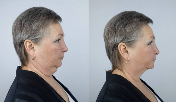Face Lift in Riyadh: Achieve a Youthful Look