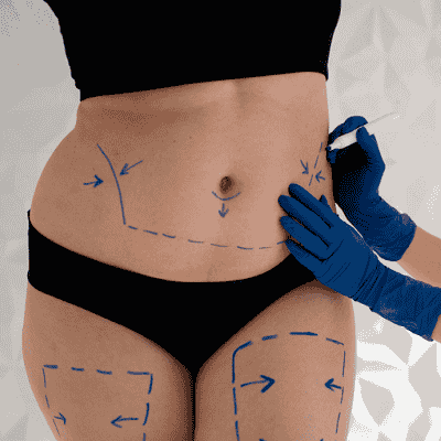Most Popular Areas for Fat Transfer Surgery in Oman