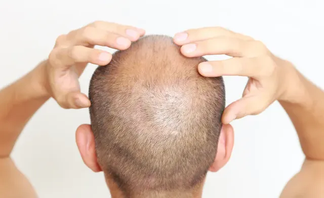 Finasteride for Hairline Recession: Can It Help?