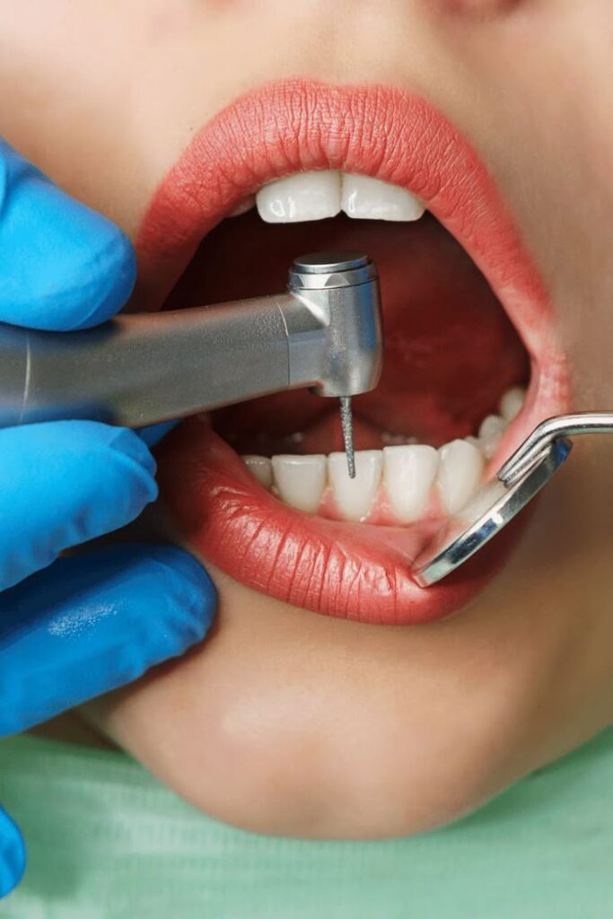 10 Benefits of Teeth Cleaning and Polishing in Riyadh