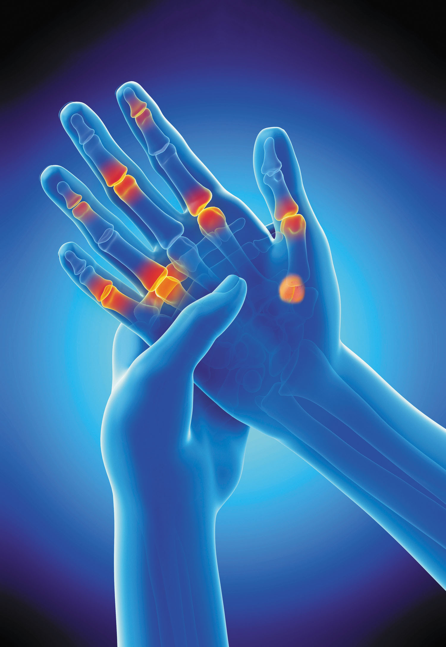 Osteoarthritis Pain: How Aspadol 100 (Tapentadol) Can Help You Regain Control