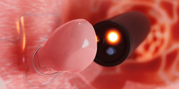 Riyadh Hemorrhoids Laser Treatment: Pros & Cons